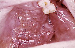 Fig. 1. Ulcera tuberculosa del paladar. Extensa lesió, irregular, amarillenta, extendiendose por gran parte del paladar duro, al lado izquierdo y hacia el fondo del vestíbulo de ese lado. La paciente también tenía compromiso pulmonar.
