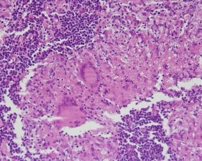 Fig. 2. Microfotografía de tuberculosis oral con dos células gigantes multinucleadas de Langhans, obsereve la disposición de núcleos hacia la perifieria. También se observan abundantes macrófagos y linfocitos.