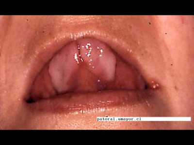 Fig. 4. Sífilis secundaria. Mujer con lesión blanco-grisácea en cara ventral de lengua, además presentaba lesiones en cara interna de mejillas y de labios. VDRL y FTA confirmaron diagnóstico.
