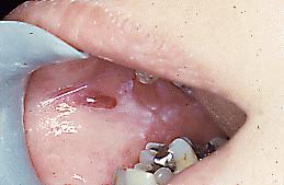 Fig. 6. Penfigoide buloso. El mismo paciente de la imagen anterior, que presentaba lesiones en cara interna de mejilla, donde se observa bula y más atrás úlcera.