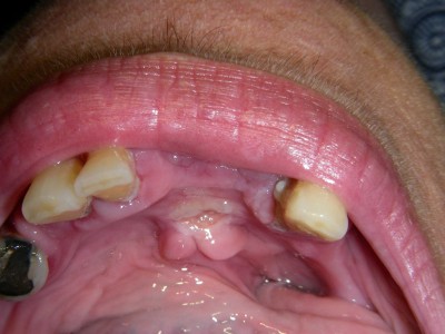 Fig. 3A. Ulcera traumática en piso de boca, con aumento de volumen en zona de desembocadura de conductos de Wharton.
