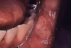 Fig. 5. Afta mayor. Ulcera socavada en cara interna del labio inferior.