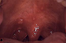 Fig. 7a. Ulceras herpetiformes en paladar blando. Observe varias úlceras pequeñas en el paladar blando con halos rojizos.