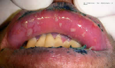 Fig. 7b. Hombre de 30 años con múltiples úlceras en cara interna de labio inferior (visto desde arriba), note zonas azulosas por indicación previa de farmaceútico de azul de metileno. Algunas úlceras han coalescido, también presentaba lesiones en cara interna labio superior y otras zonas.