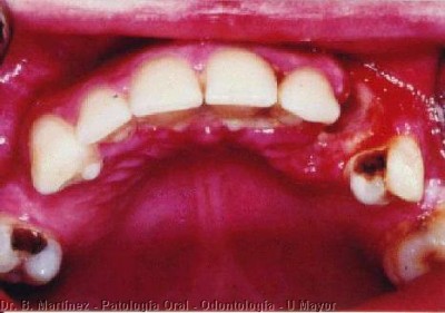 Fig. 12. Gingivitis necrotizante en encía palatina, que además presentaba alveolitis, zona del canino