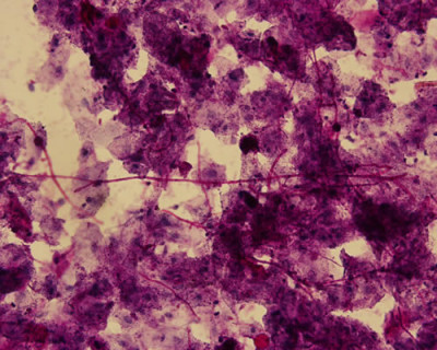 Fig 2. Al centro se observa larga hifa (color fucsia) de cándida, rodeada por células epiteliales. Frotis de paciente hombre 24 años con candidiasis seudomembranosa del paladar. Tinción PAS, aumento original 500X.