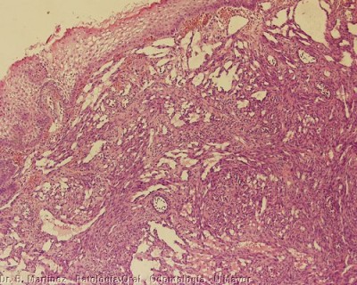 Fig. 9. Histopatología de Sarcoma de Kaposi de la encía, donde se observa epitelio y bajo él abundantes vasos de formas y lúmenes irregulares, y proliferación de células fusadas entre ellos. Tinción H&E, aumento original 100X.