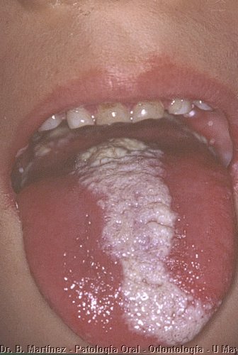 Fig. 10.4. Dorso de lengua con área blanquecina al medio.