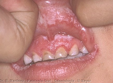 Fig. 10.5. Cara interna de labio superior y mucosa gingival