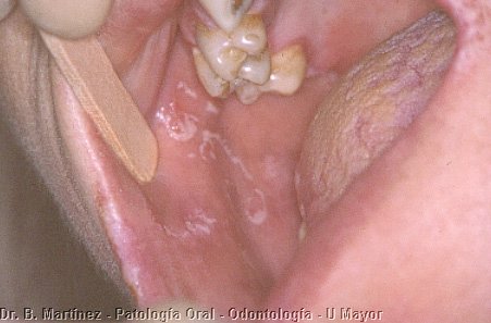 Fig. 9.3. Cara interna de mejilla con lesiones blanquecinas.