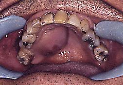 Fig. 16. Carcinoma lobular polimorfo de bajo grado de malignidad del paladar. Note zonas enrojecidas y límites, en algunas partes, difusos.
