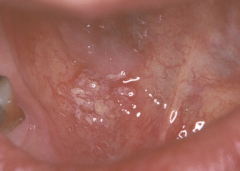 Fig. 1. Caso 1. Area blanquecina en piso de boca, verrucosa, con enrojecimiento en la periferia. Note también cambio de color, más grisáceo de la mucosa hacia la parte posterior de la lesión.