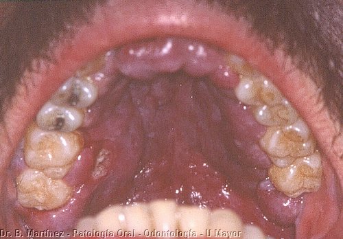 Fig. 12.1. Extenso tumor ulcerado en zona de molar derecho, y de color rojizo sin dejar ni un mm sano de mucosa palatina.