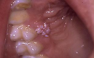 Fig. 1. Papiloma de la encía, zona de premolares superiores. Lesión con proyecciones papilares, con aspecto más o menos de coliflor,blanquecina.
