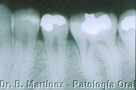 Fig 3.1. Radiografìa periapical de premolares inferiores.