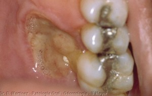 Fig. 5.1 Úlcera socavada en encía palatina de primer molar superior, muy dolorosa que había aparecido aproximadamente un mes antes.