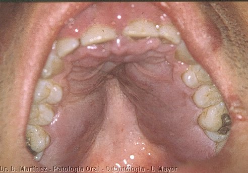 Fig. 11.2. Tumoración extensan en paladar, note también la tumoración gingival en la zona anterior, y lesiones labiales.