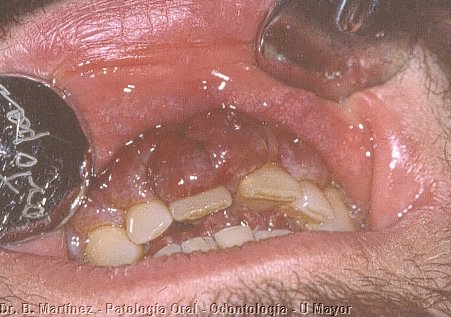 Fig. 12. 2. Tumoración rojo violácea, gingival cubriendo en parte las coronas dentarias.