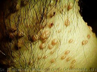 Fig. 2.2.. Piel del cuello con múltiples lesiones nodulares, rojizas y zon zonas blanquecinas, umbilicadas.