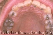 Fig. 3. 2. Manchas rojo violáceas en paladar duro, más o menos cerca a molar superior derecho y también en encía palatina de premolar izquierdo.