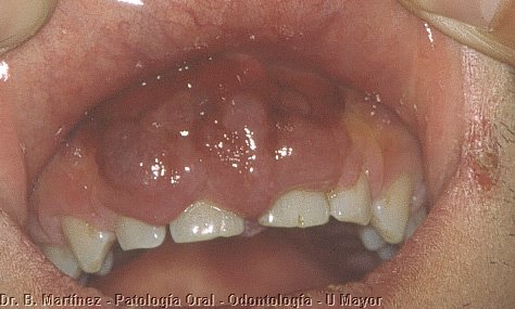 Fig. 11.3. A diferencia de la tumoración palatina, la lesión gingival presentaba un color rojo más intenso y comprometía hasta el fondo del vestíbulo.