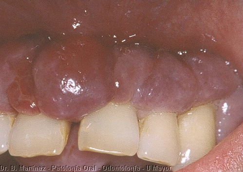 Fig. 12.3. Acercamiento de la tumoración gingival, que desplazaba en parte los incisivos.