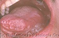 Fig. 4.3. Erosión en borde de lengua de aproximadamente dos cm por un cm, de borde irregular.