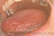 Fig 5.3. Borde de lengua 10 días después de tratamiento.