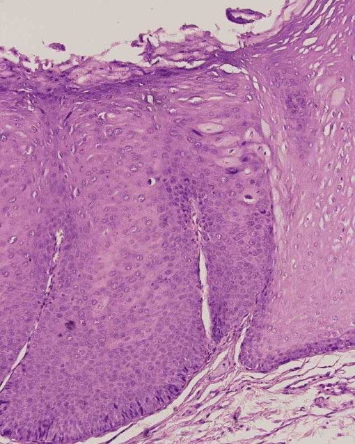 Fig. 19.5 Atipías similares a las descritas en figura anterior, y células tipo coilocíticas en estrato espinoso, con halo claro, y citoplasma hipercromático.