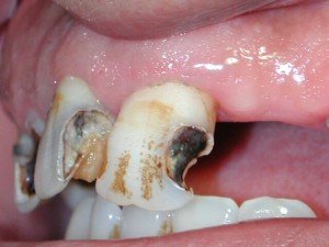 Fig.11. Caries dentinarias profundas