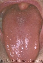 Fig. 8.1. Area blanquecina en dorso lingual por delante de la V lingual, y prácticamente todo el dorso se observa de aspecto liso, brillante, depapilado.