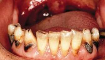 Fig. 2. Imagen de paciente con recesión gingival y presencia de caries cervical.(Imagen obtenida de:http://img.tfd.com/mosby/thumbs/500051-fx7.jpg)
